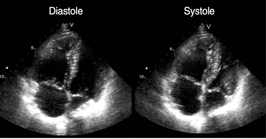 Apical four-chamber POCUS image showing right-heart strain.