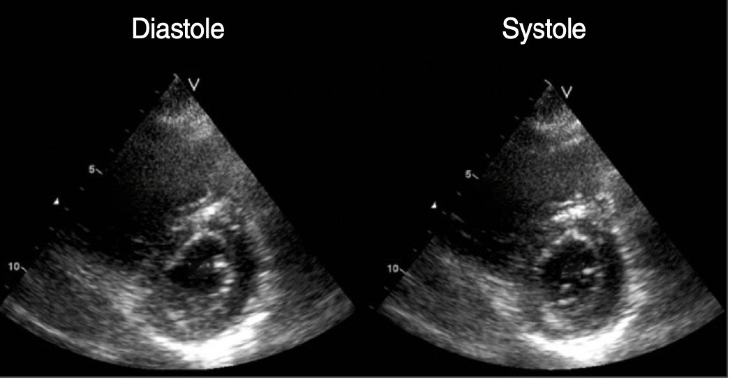 Parasternal short-axis POCUS image showing right-heart strain.