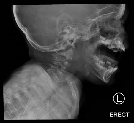 Lateral neck x-ray showing retropharyngeal soft-tissue swelling.