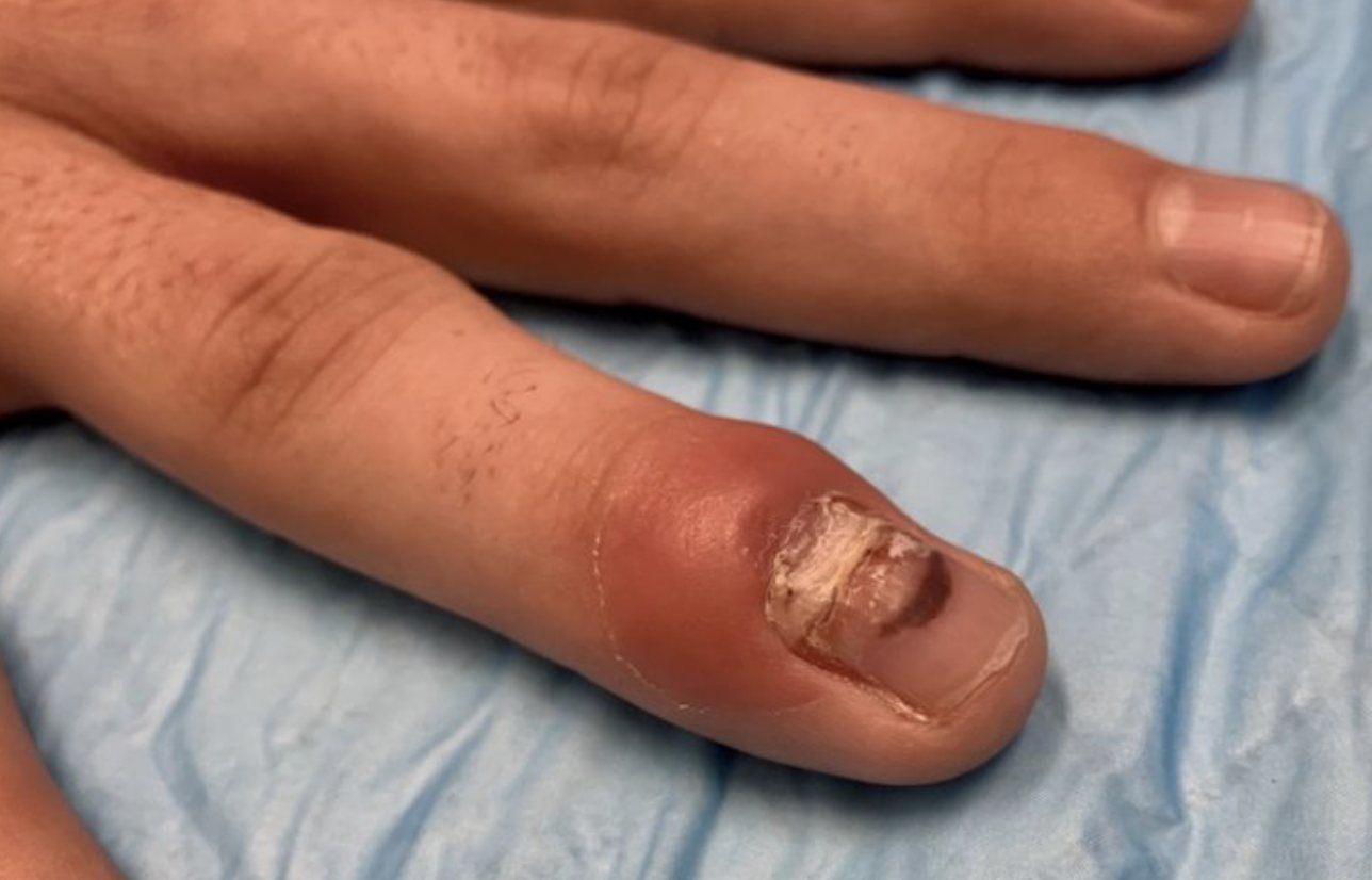 Photo of the swollen distal ring finger and nail fold.