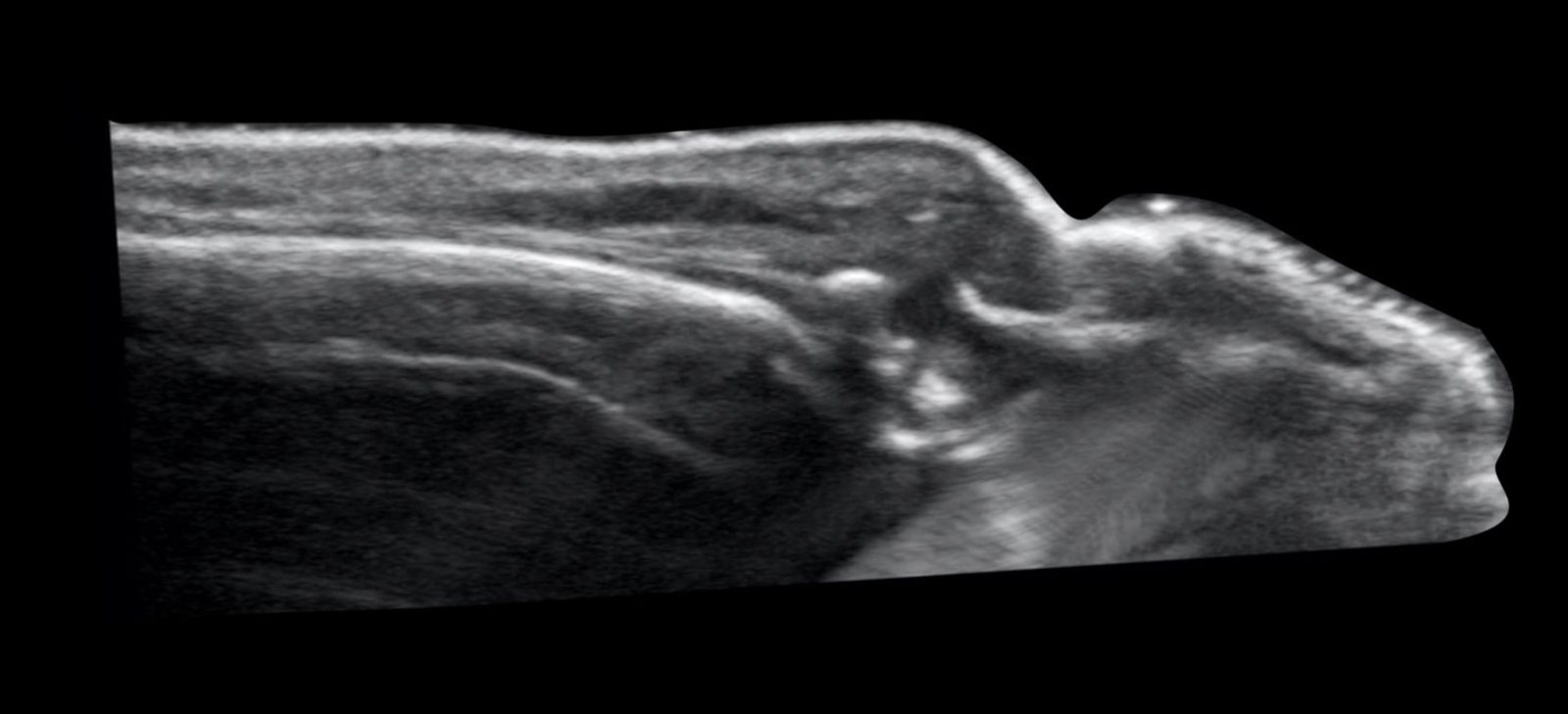 Ultrasound image of the painful distal finger.