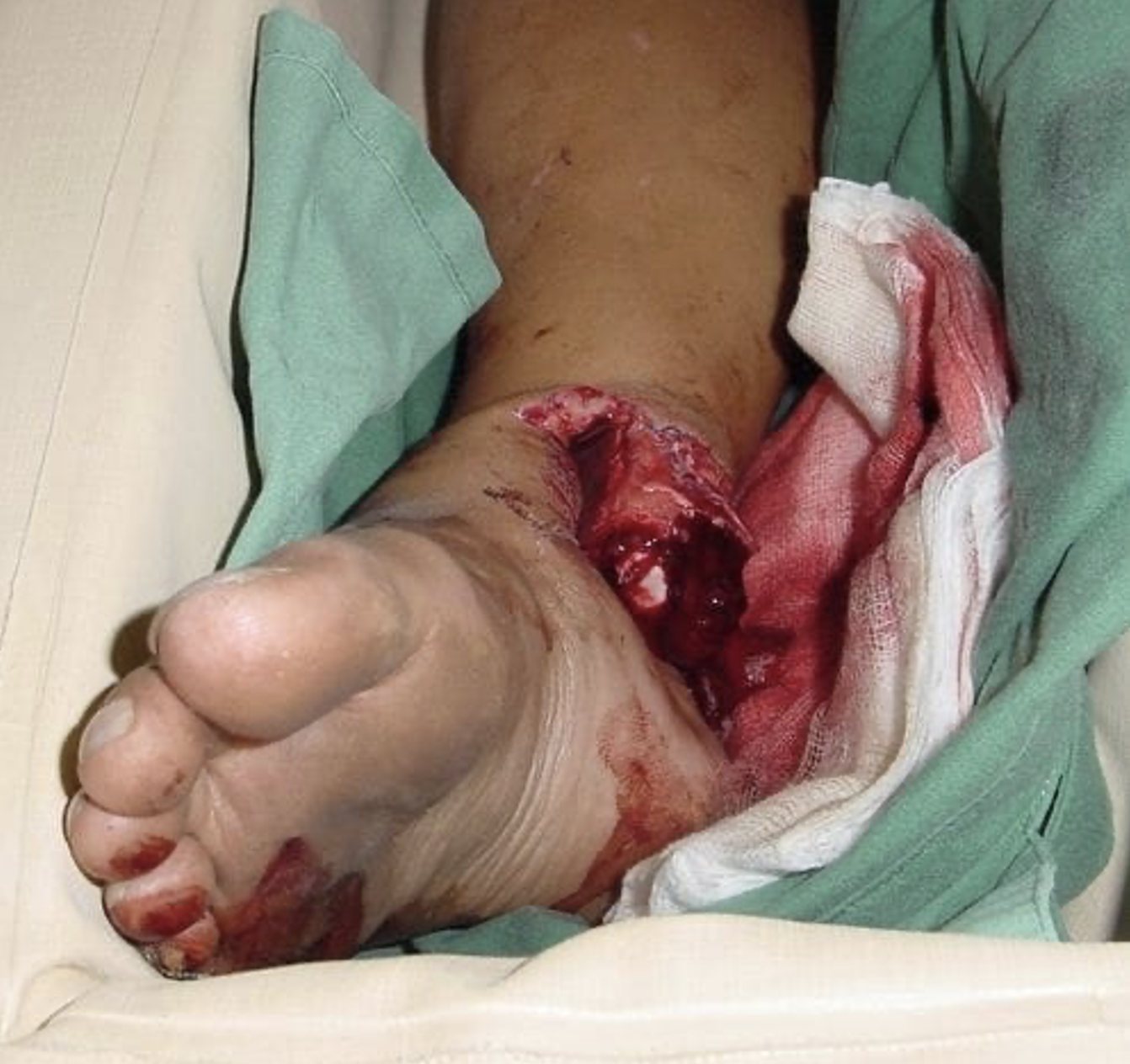 Clinical photo of the open right lower limb injury.