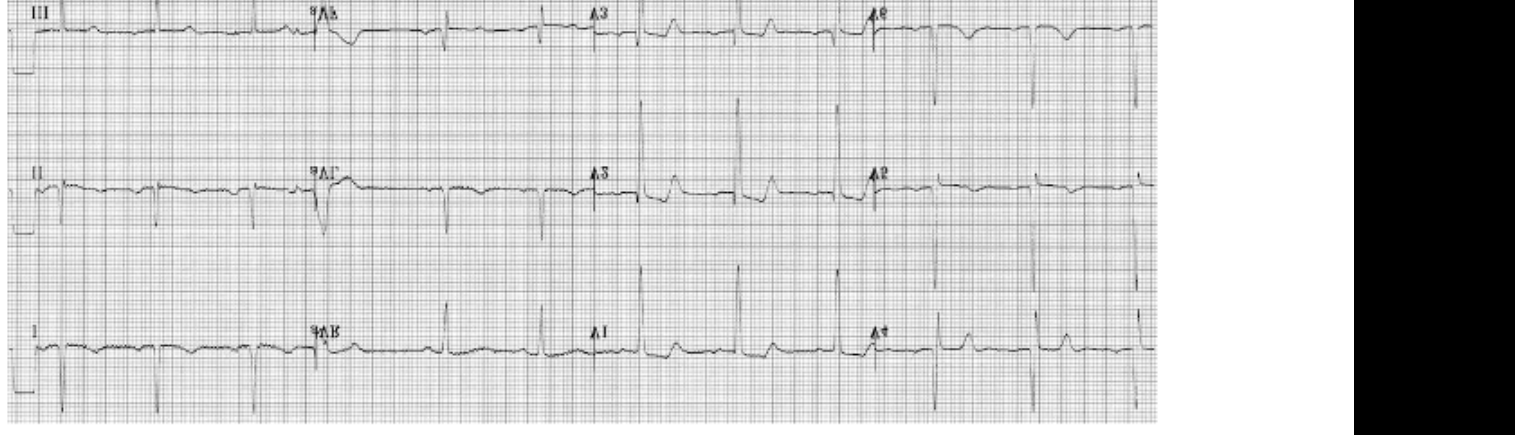 ECG following a resolved episode of chest pain.