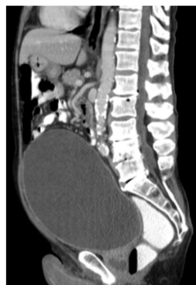 Sagittal CT image of abdomen and pelvis.