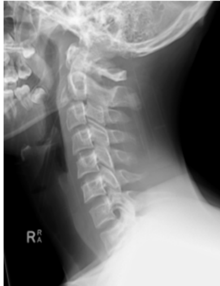 Lateral cervical spine X-ray.