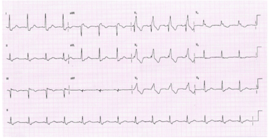 12-lead ECG from a patient with chest pain and COPD.