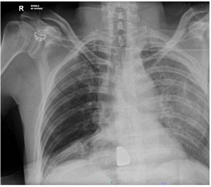 Initial chest X-ray after blunt trauma.