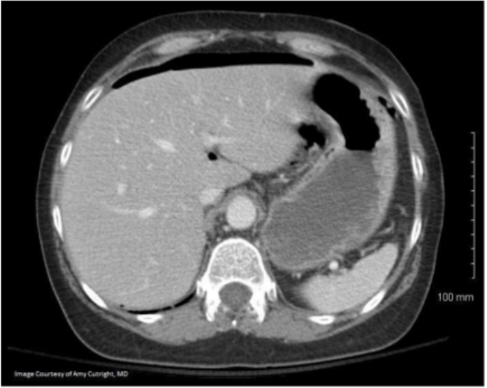 CT abdomen showing pneumoperitoneum.