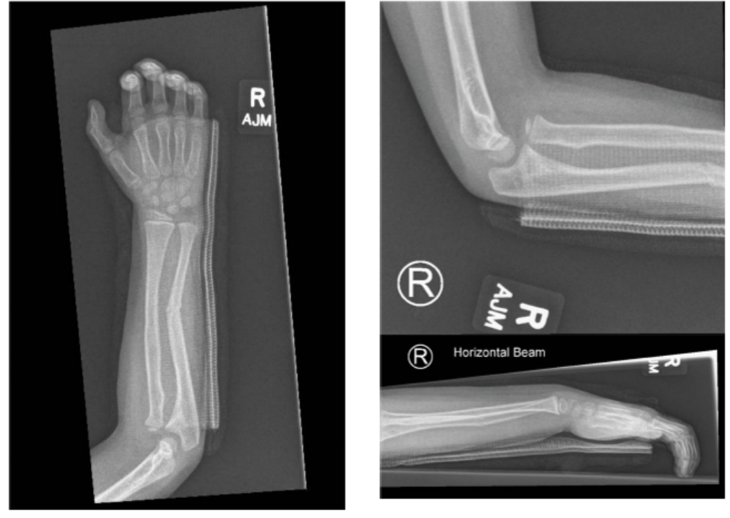 Right forearm and elbow x-rays after a fall.