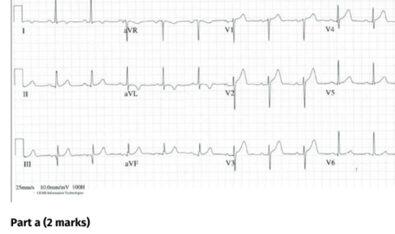 Arrival ECG from a patient with chest pain.