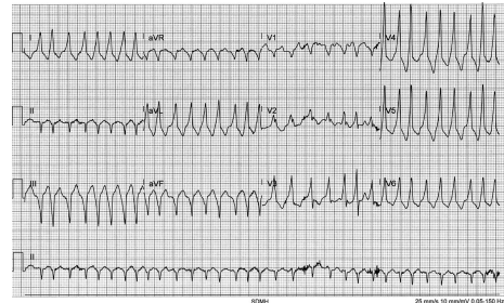 Initial ECG from a patient with palpitations and recurrent syncope.