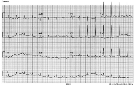ECG after successful pharmacological treatment.