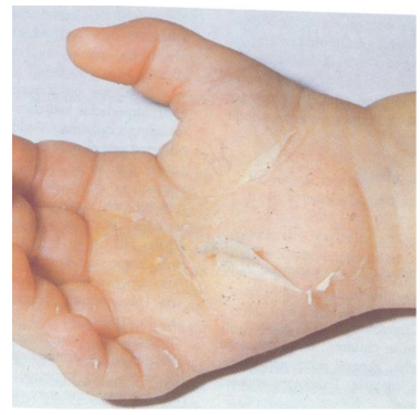 Hand rash in a child with fever being assessed for Kawasaki disease.