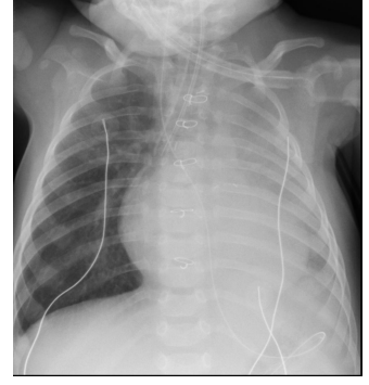 Chest x-ray after endotracheal tube placement.