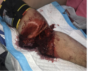 Traumatic right upper limb injury after train-related crush injury.