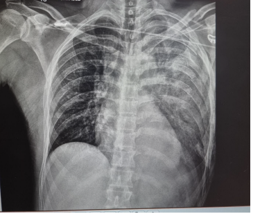 Portable chest x-ray after blunt chest trauma.