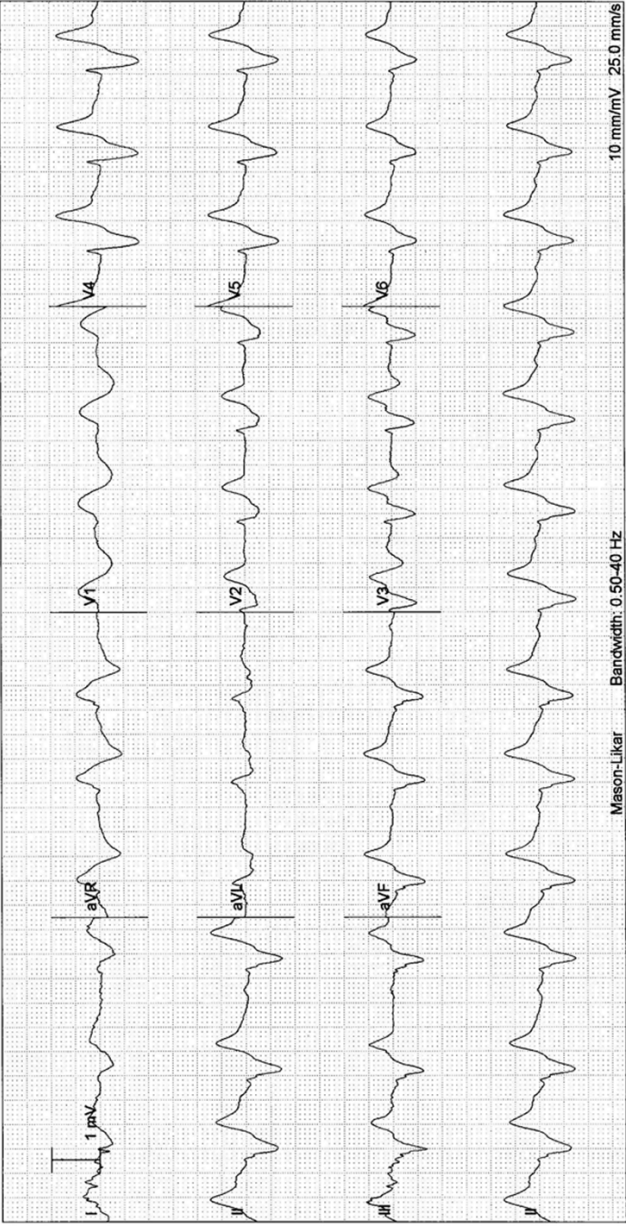 ECG showing severe hyperkalaemic changes.
