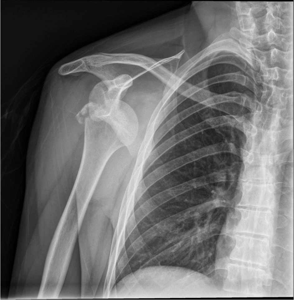 AP shoulder X-ray showing anterior shoulder dislocation with greater tuberosity fracture.