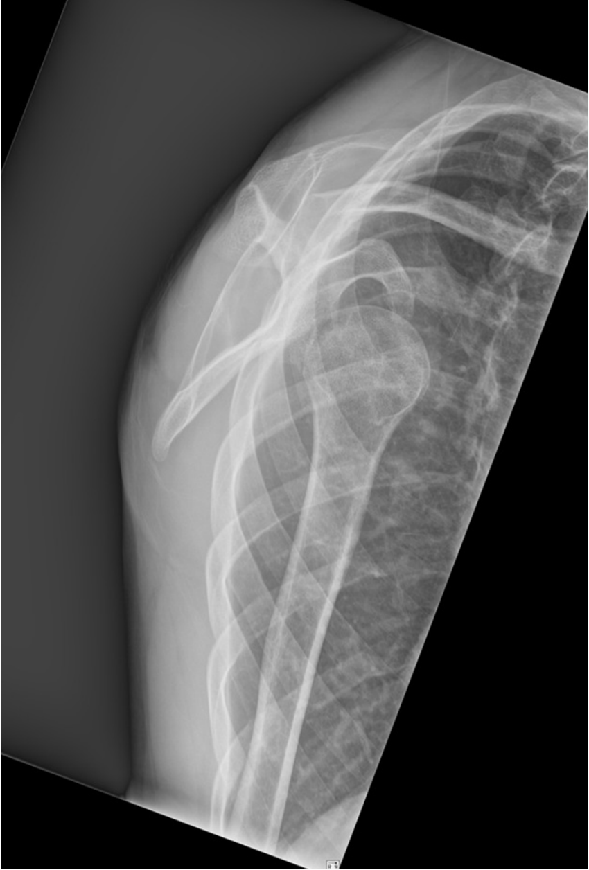 Lateral shoulder X-ray showing anterior shoulder dislocation.