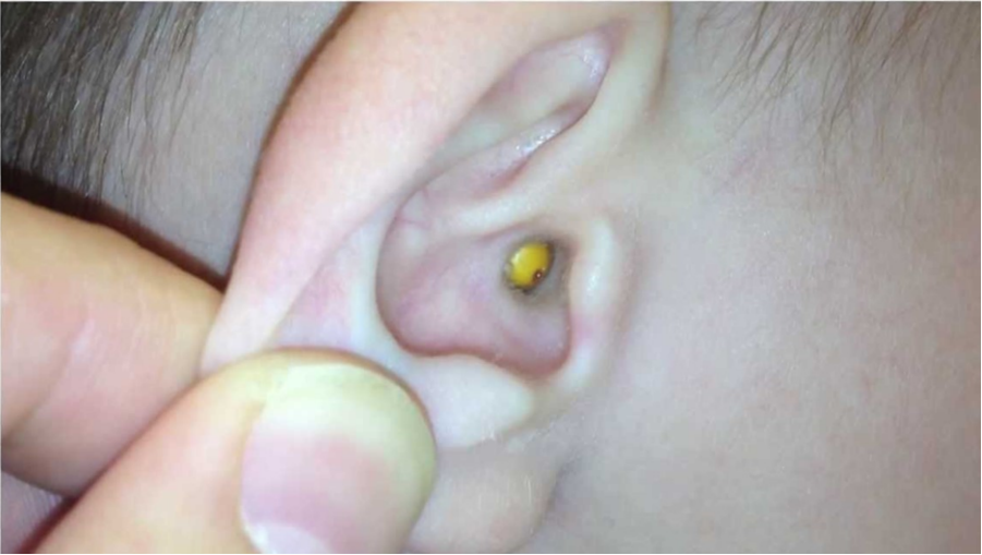 Photograph showing a yellow popcorn kernel in a child's external auditory canal.