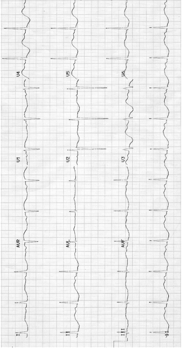 ECG with changes consistent with severe hypokalaemia.