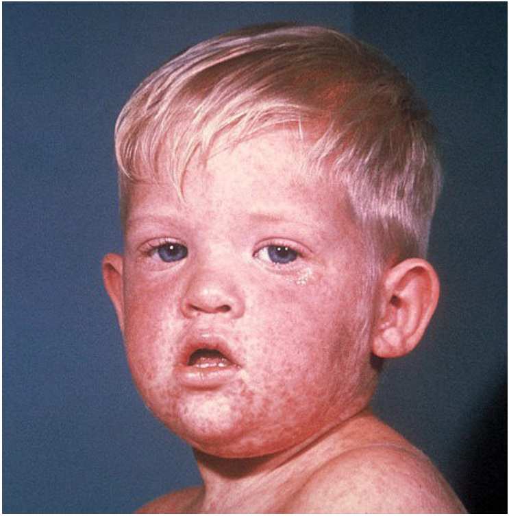 Clinical photograph of a febrile child with a facial rash.