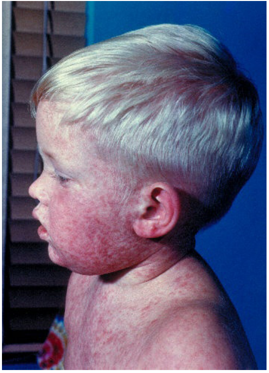 Clinical photograph of a febrile child with a rash on the head and upper trunk.