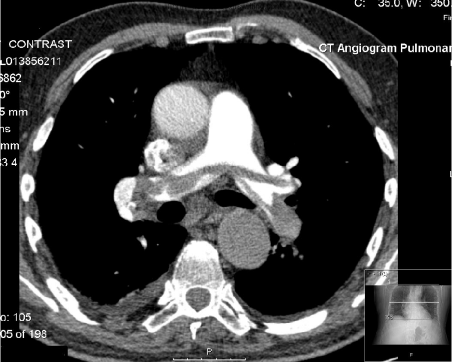 CTPA axial image showing a saddle pulmonary embolus.
