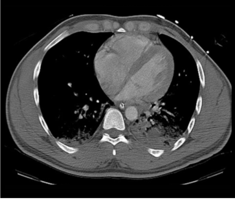 CTPA axial image showing right-heart strain features.