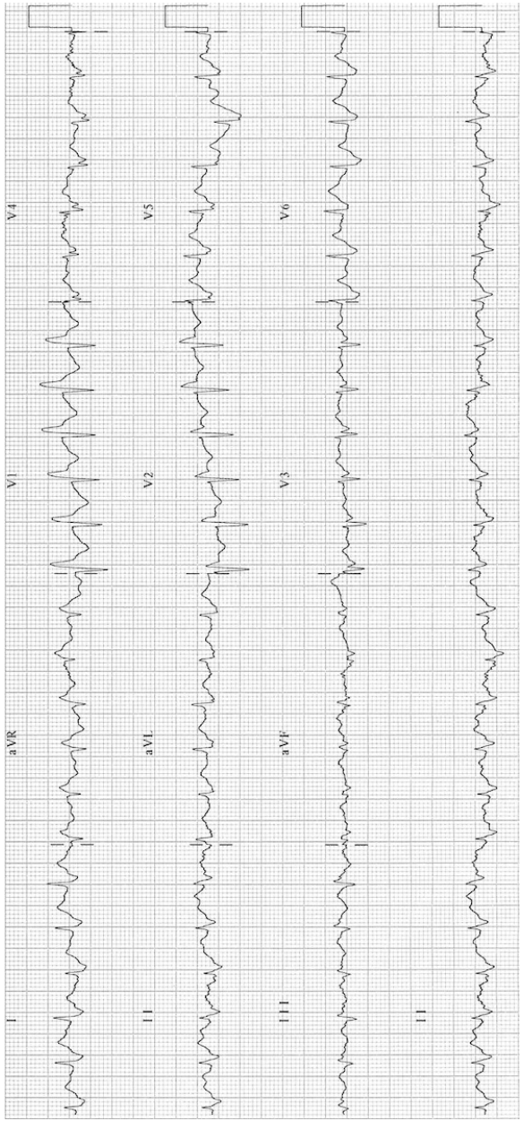 ECG in a pregnant patient with suspected pulmonary embolism.