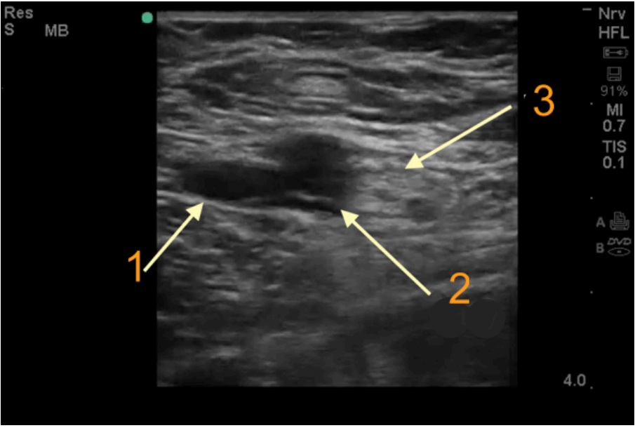 Ultrasound image of femoral neurovascular structures labelled 1 to 3.