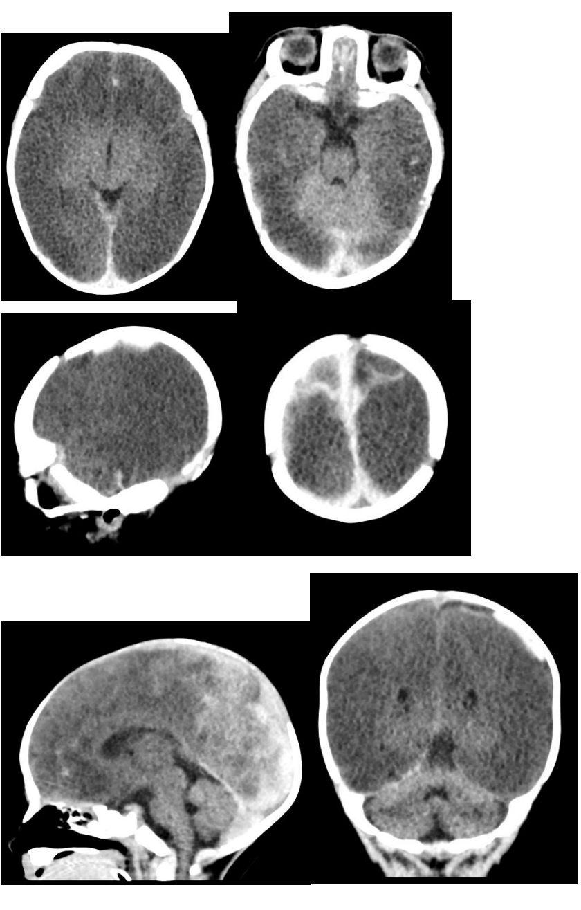 CT brain images for an unresponsive infant, first set.