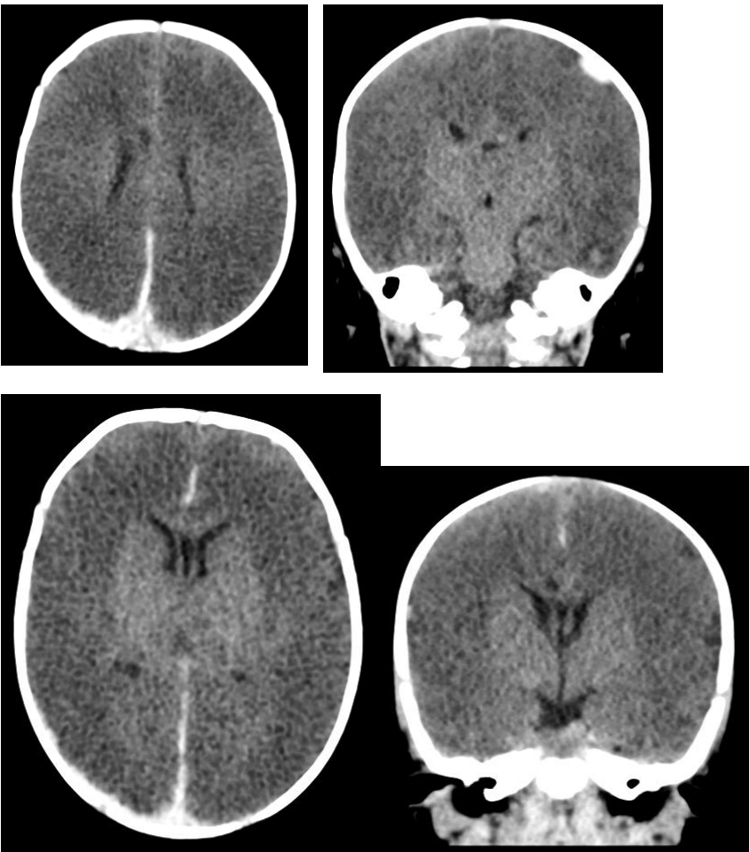 CT brain images for an unresponsive infant, second set.