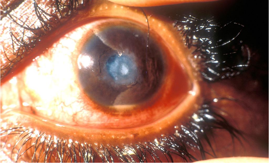 Close-up eye photograph showing corneal opacity and conjunctival injection.