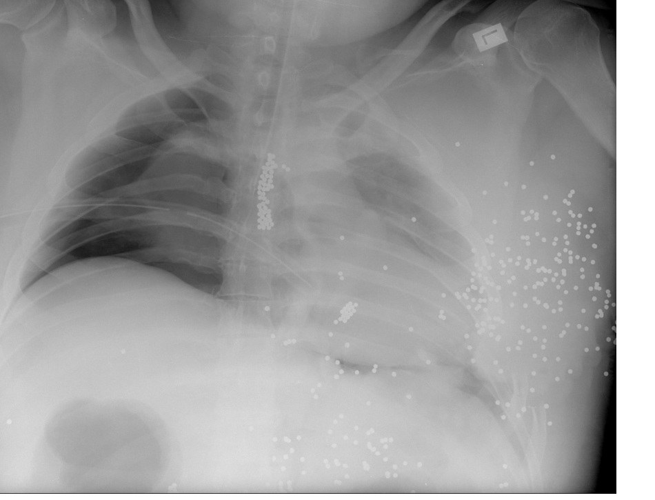 Supine chest X-ray after shotgun injury with right pneumothorax and thoracic pellets.