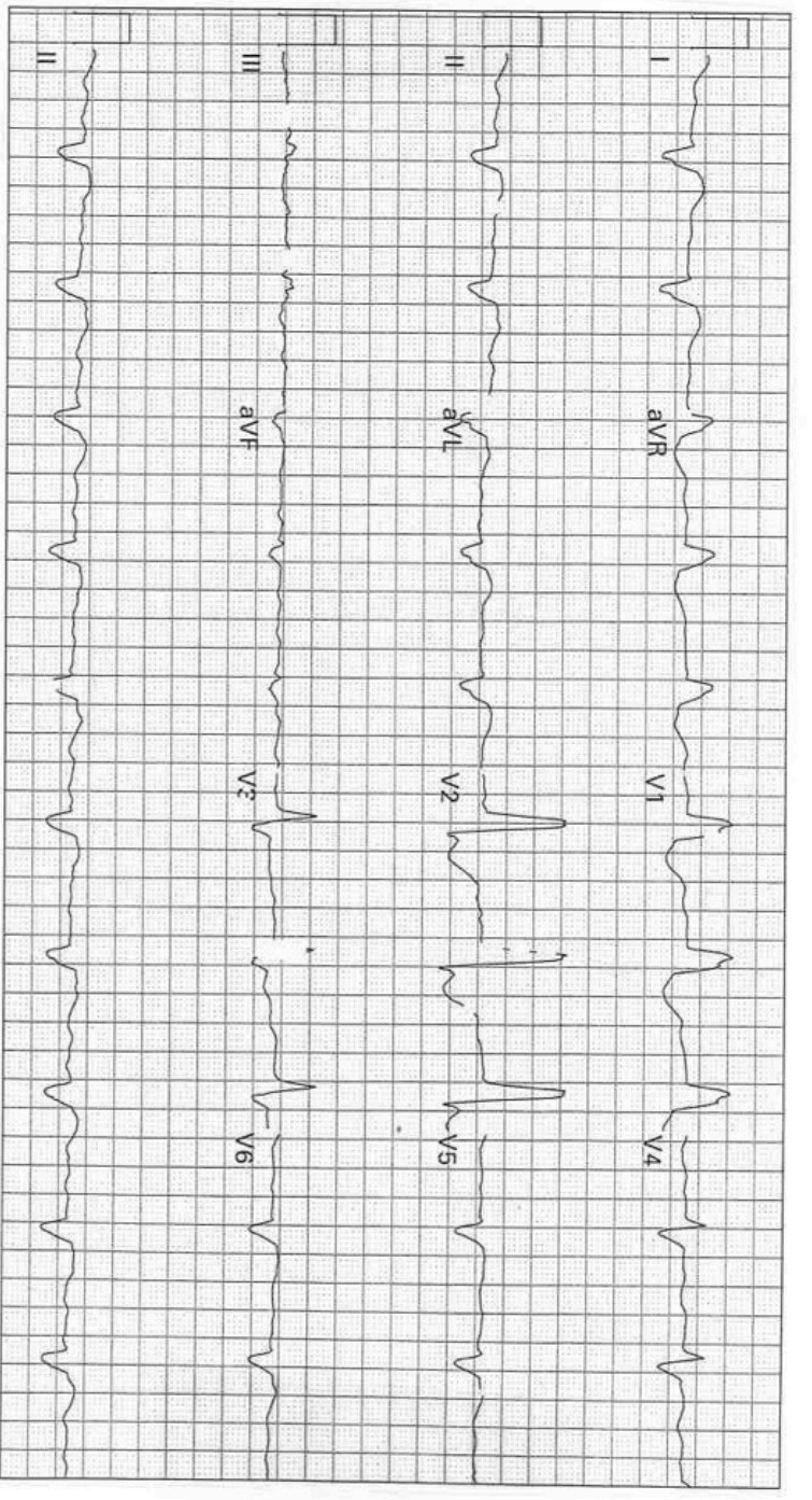 ECG showing regular broad complexes in atrial fibrillation, consistent with severe conduction disturbance.