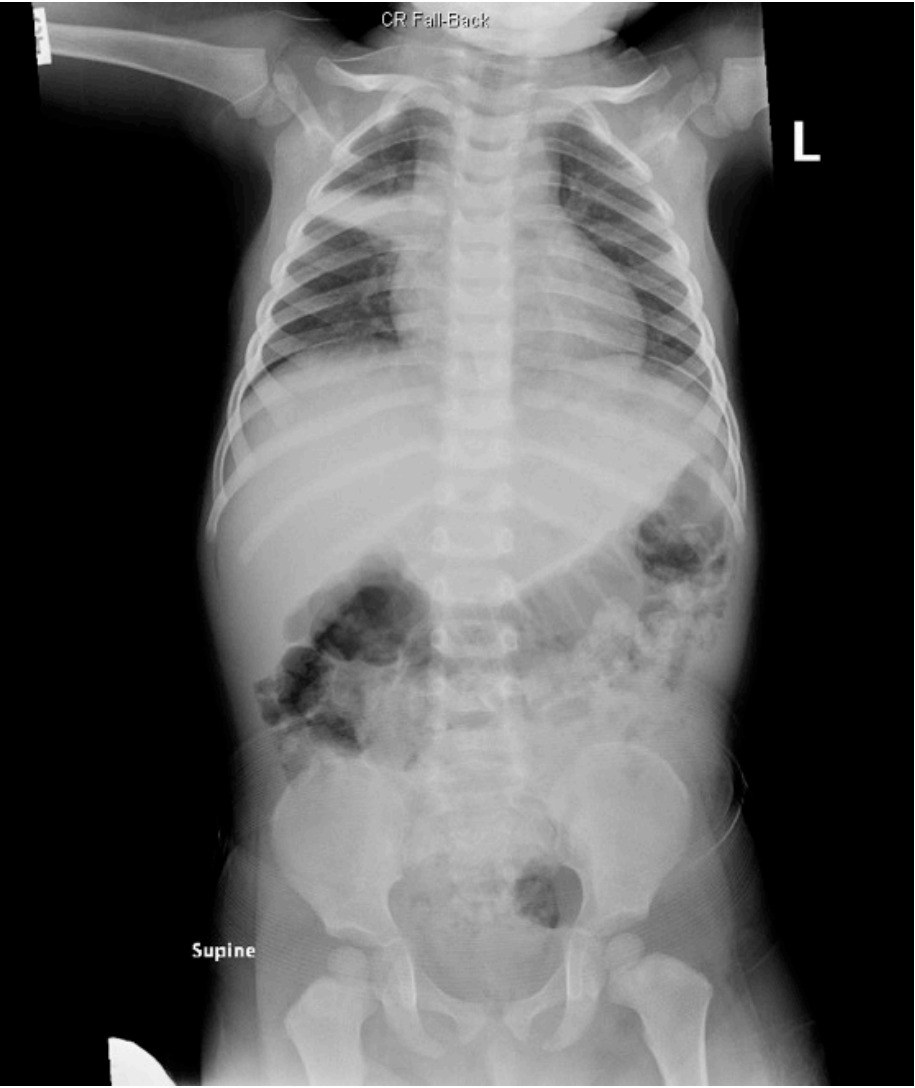 Paediatric chest and abdomen X-ray showing right upper-zone consolidation without visible gastric iron tablets.