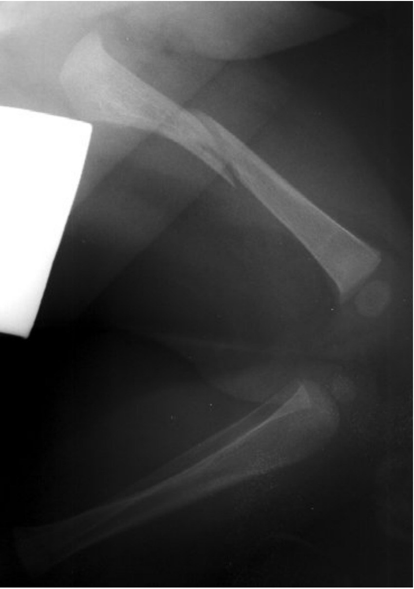 Femur and knee X-ray for a young child with leg pain.