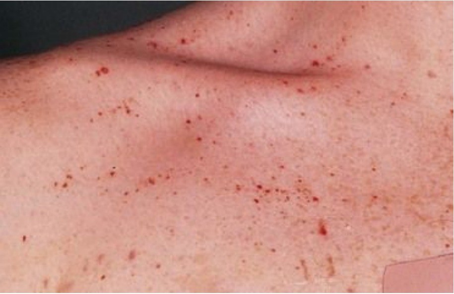 Clinical image of a chest rash in a febrile child.