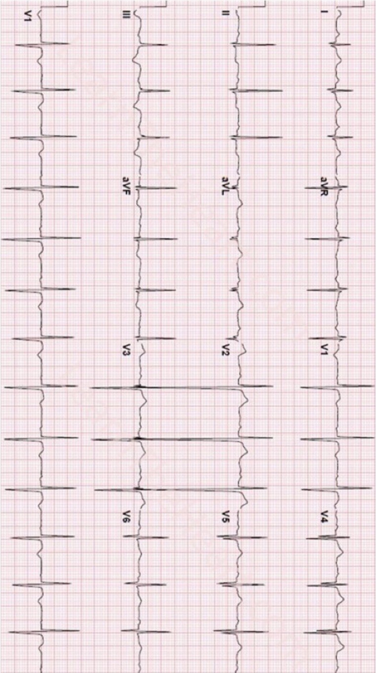 ECG in a teenage patient with exertional syncope.