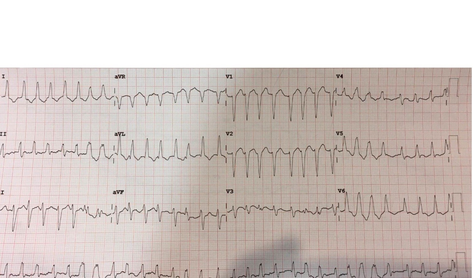 Initial 12-lead ECG in an older patient with palpitations.