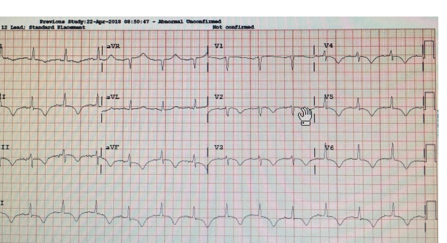 Repeat 12-lead ECG after treatment.