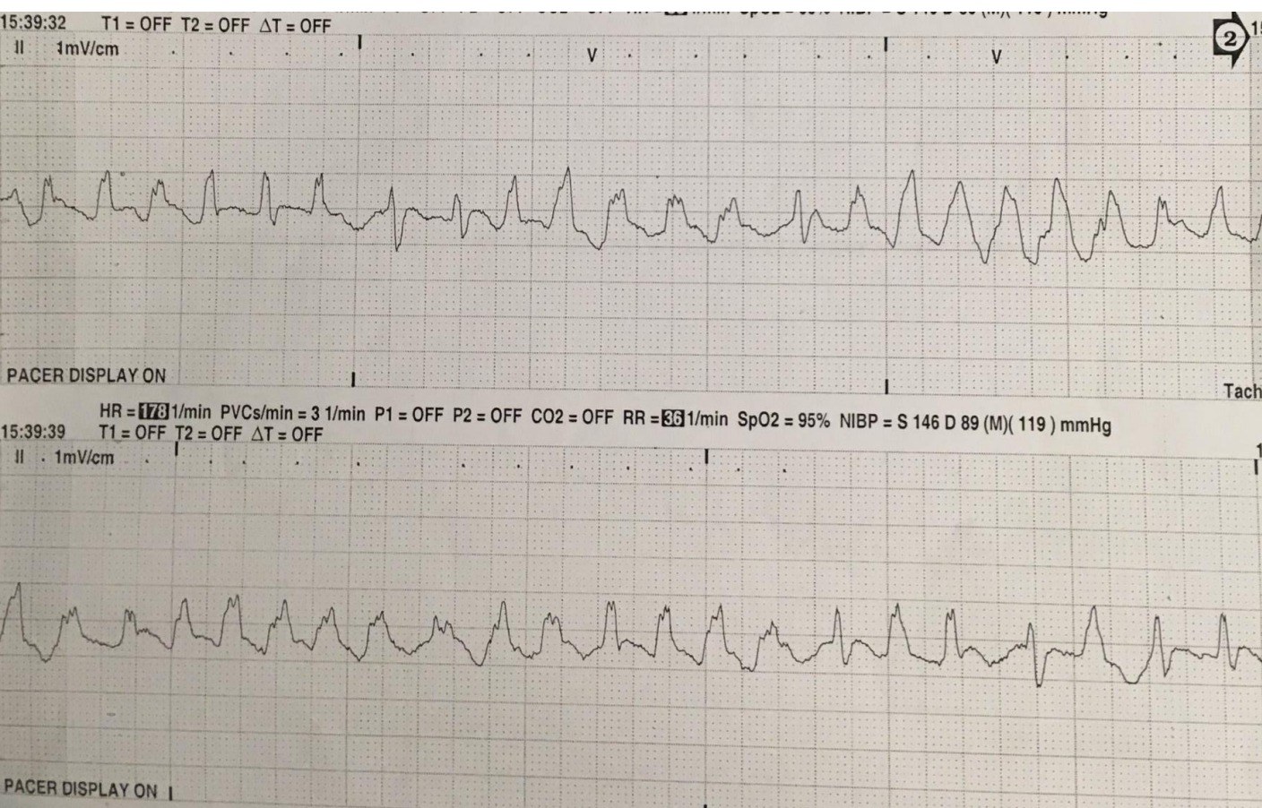 Monitoring rhythm strip during clinical deterioration.