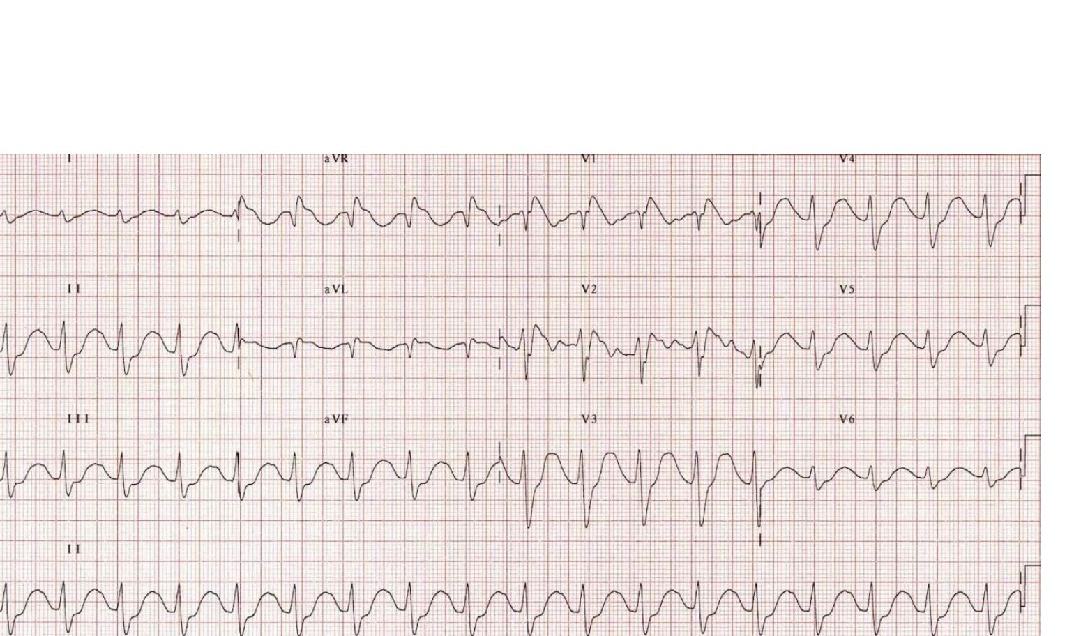 ECG obtained after seizure in a patient with cocaine-related chest pain.