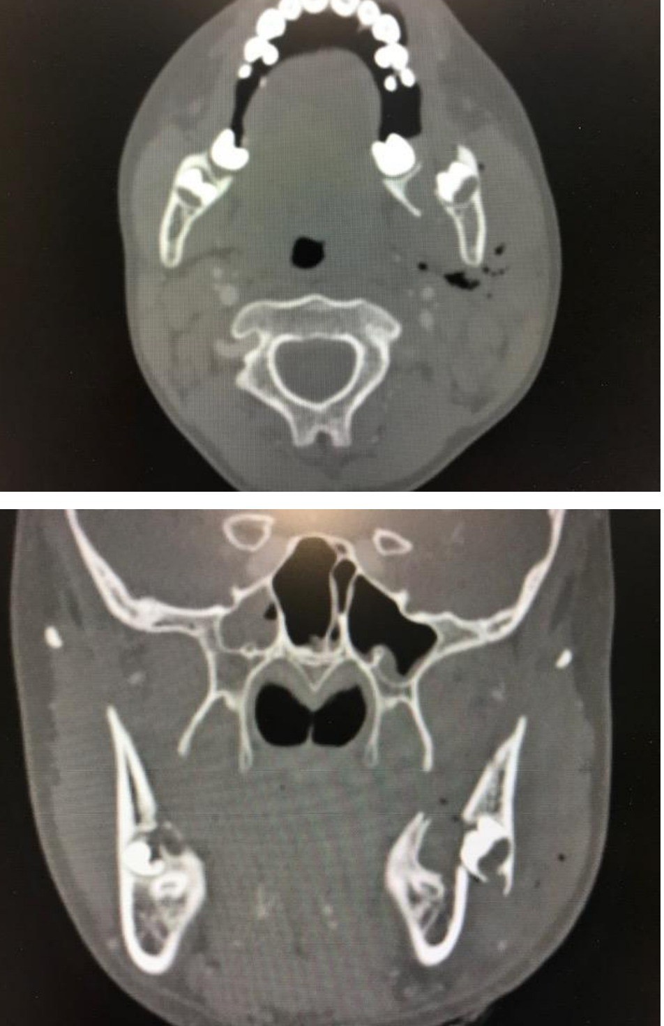CT face axial and coronal views for the trauma scenario.