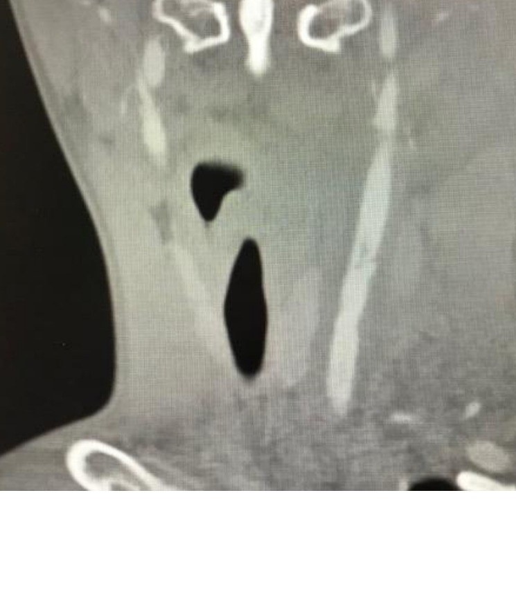 Coronal CT angiogram image for the neck trauma scenario.