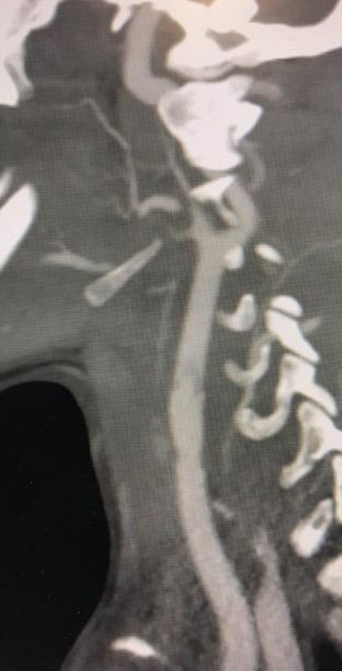 Sagittal CT angiogram image for the neck trauma scenario.