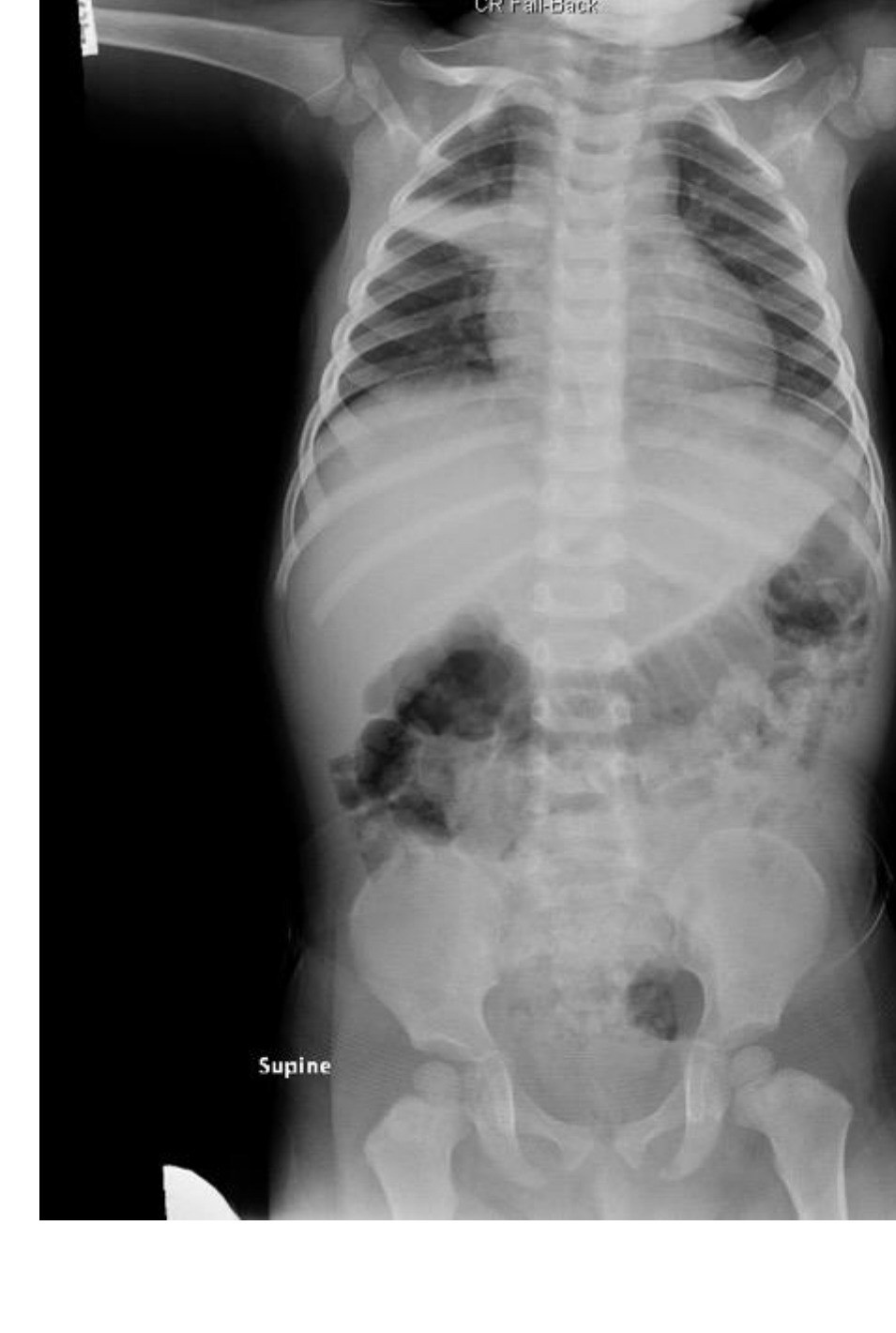 Supine paediatric abdominal and chest radiograph for the ingestion scenario.