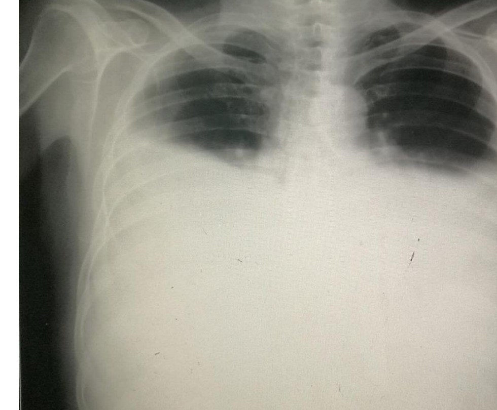 Chest radiograph for the dyspnoea and hypoxia scenario.
