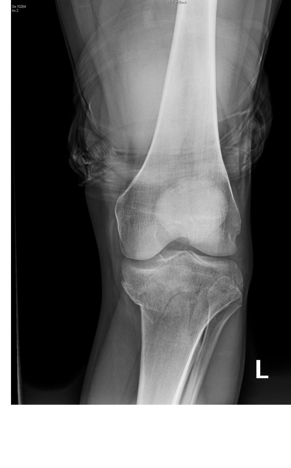 AP left knee X-ray for the hyperextension injury scenario.